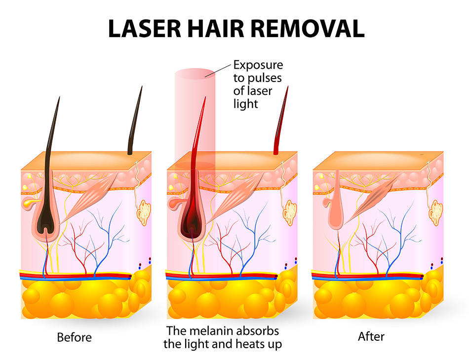 Diode Lasers More Than Skin Deep Cosmetic Benefits Coherent